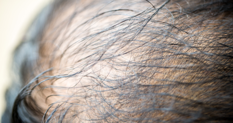 Thinning Hair: Causes, Types, and Remedies
